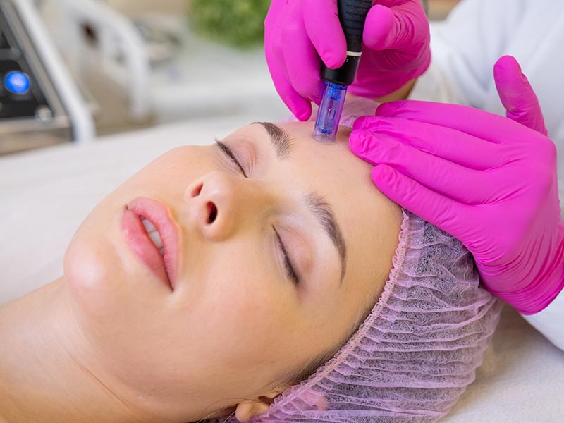 Microneedling