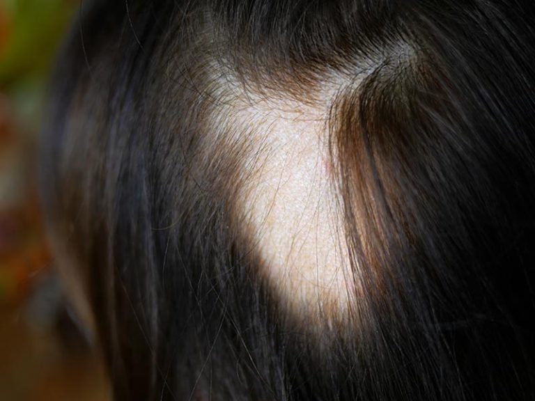 Alopecia Areata