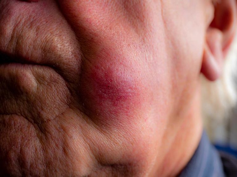 Basal Cell Carcinoma