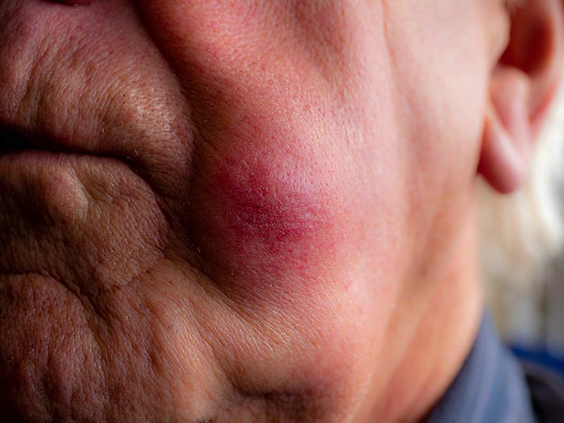 Basal Cell Carcinoma