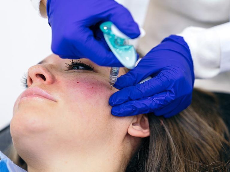 Botox® Cosmetic Treatment for Hyperhidrosis