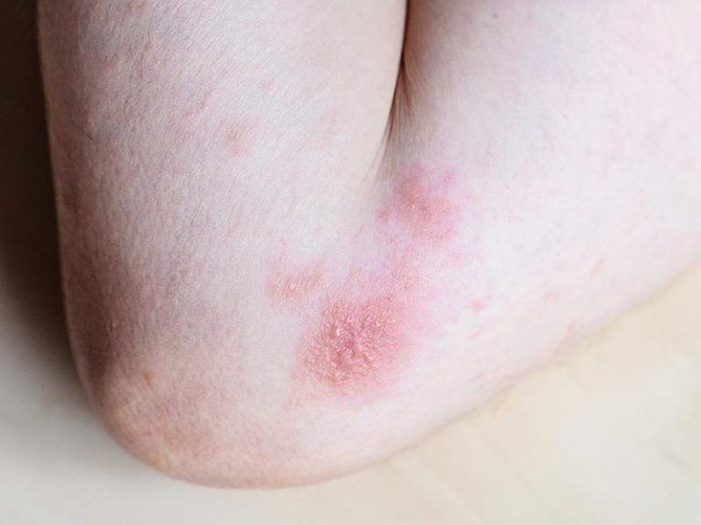 Eczema
