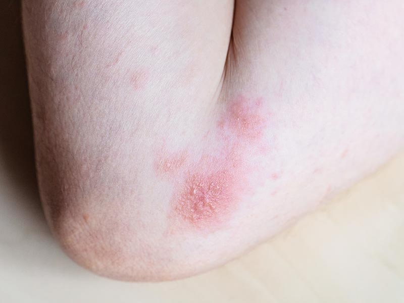 Eczema