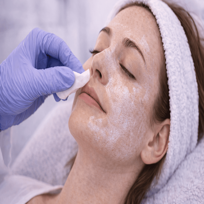 Trichloroacetic Acid Peel
