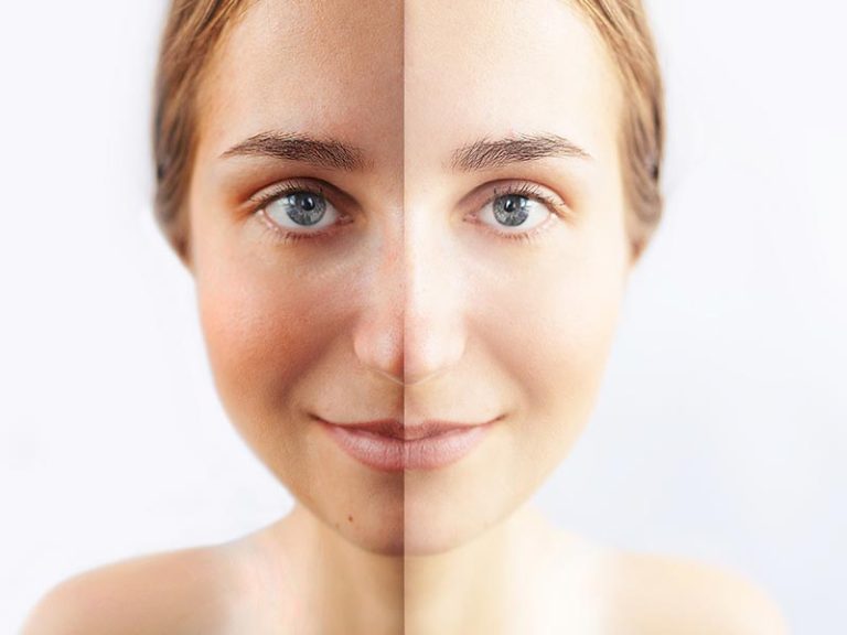 Intense-Pulsed-Light Skin Rejuvenation