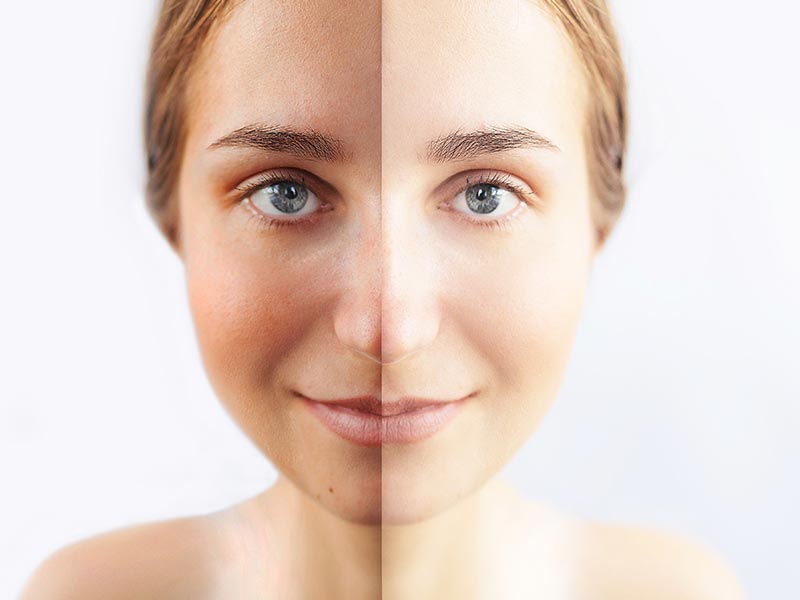 Intense-Pulsed-Light Skin Rejuvenation