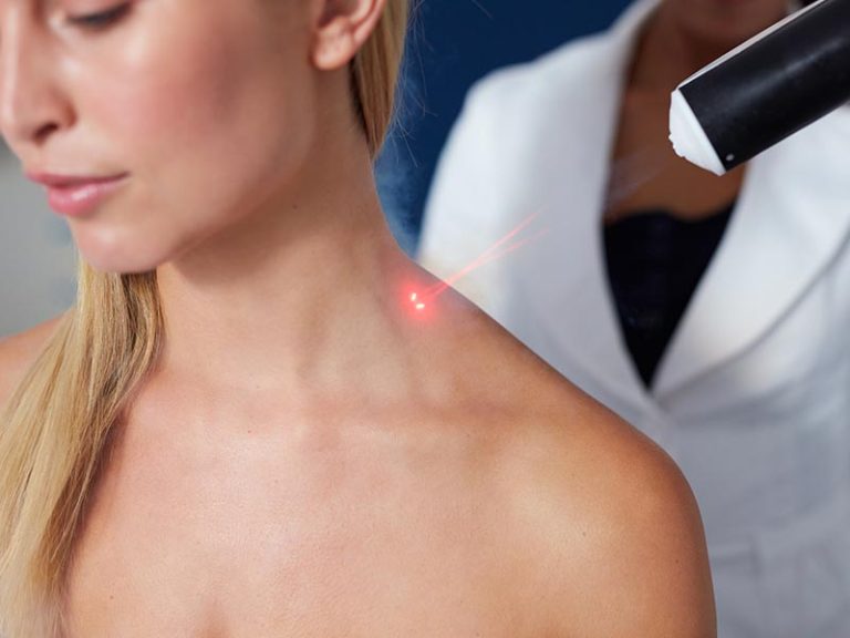 Lumenis® M22™ Resurfx™ Laser Treatment