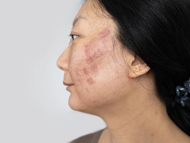 Melasma