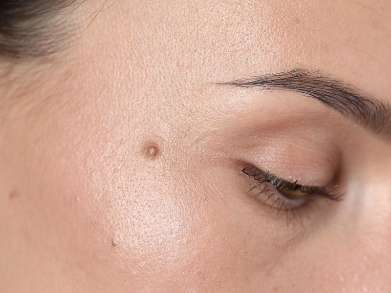 Moles and Birthmarks