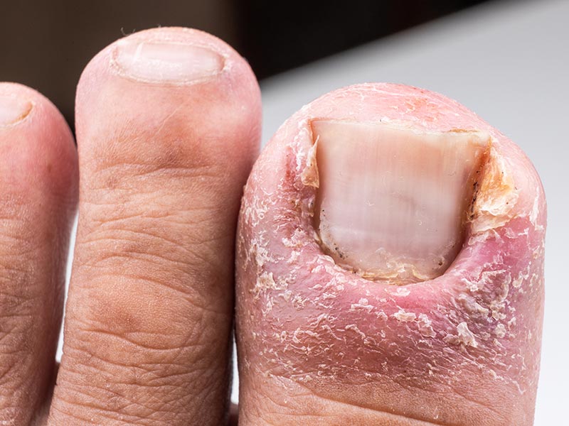 Mycotic Nail Infections