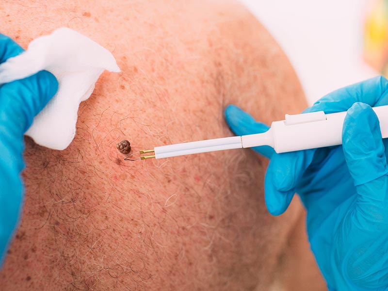 Seborrheic Keratoses