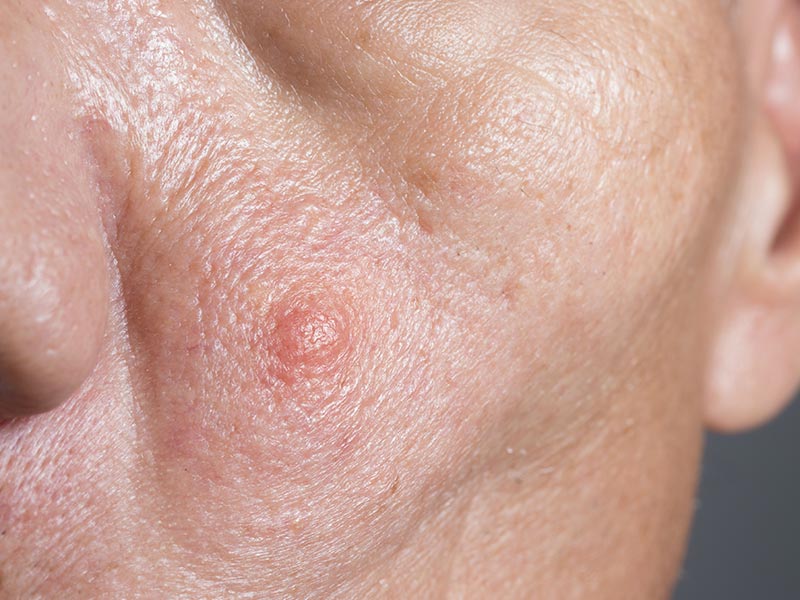 Squamous Cell Carcinoma