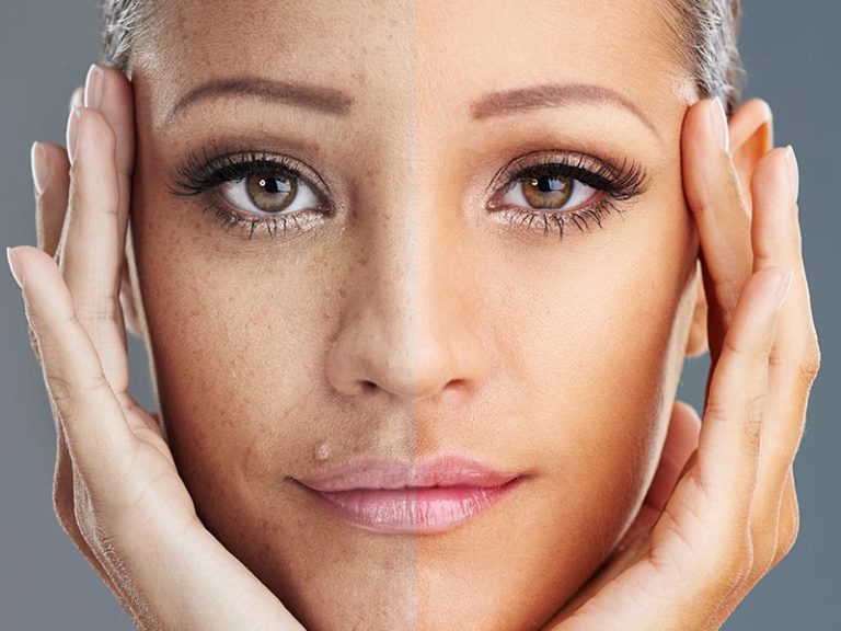 Treatment For Facial Discoloration