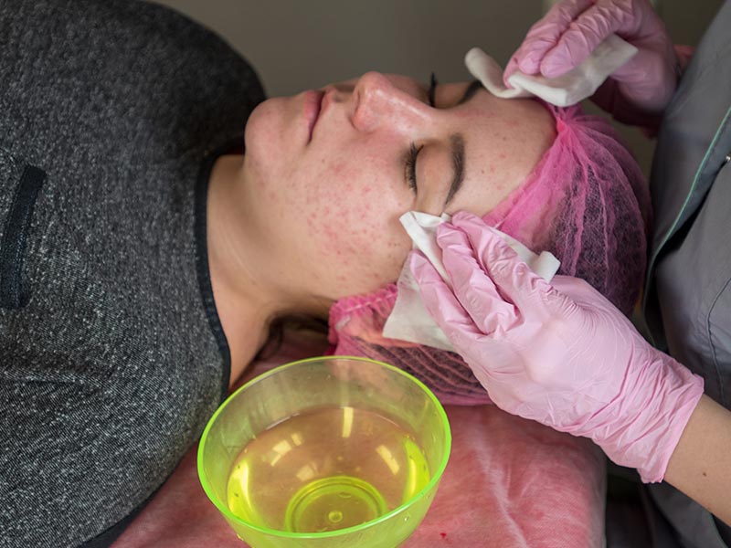 Trichloroacetic Acid Peel